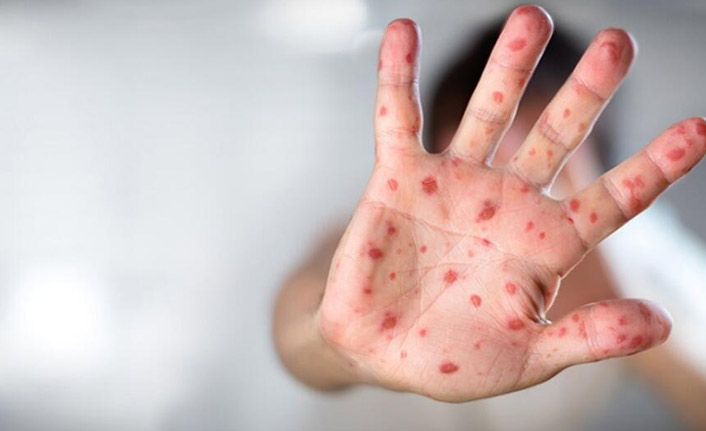 DSÖ Alarma geçmişti Maymun Çiçeği Virüsü bir ülkeye daha sıçradı