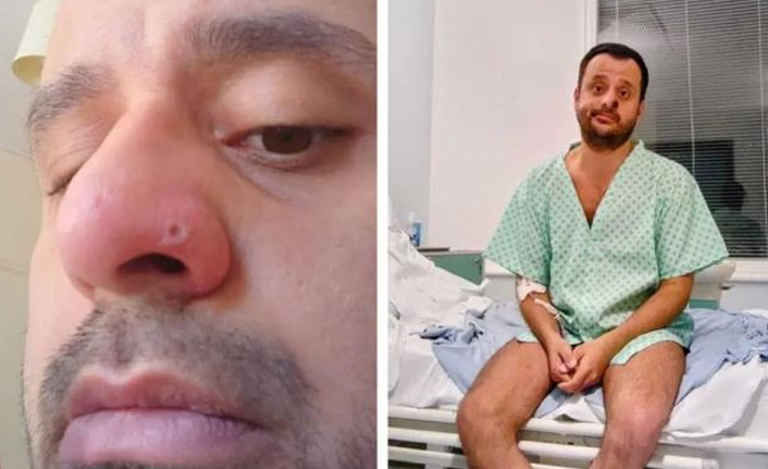 Maymun çiçeğine yakalanan Türk: "Öleceğimi sandım"