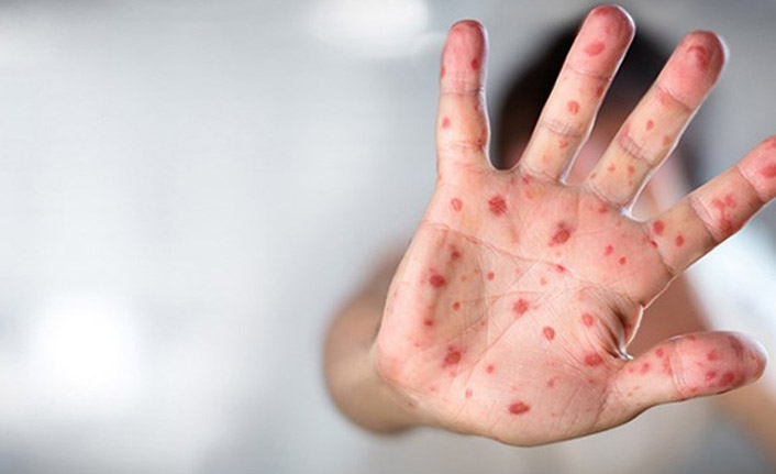 Sağlık Bakanlığı'ndan 'maymun çiçeği' rehberi