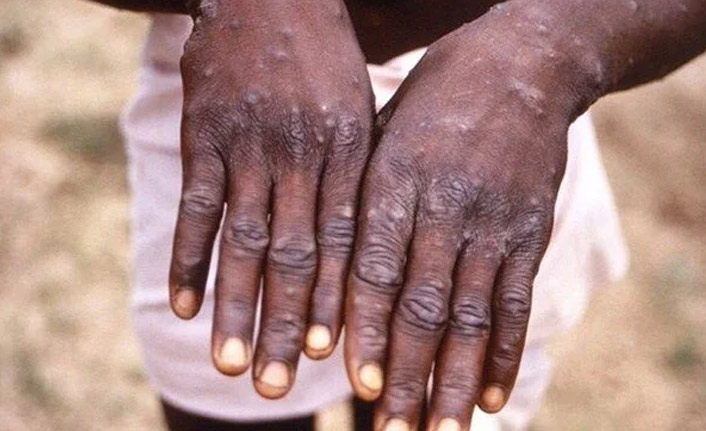 Maymun çiçeği hızla yayılıyor Asya'da ilk ölüm