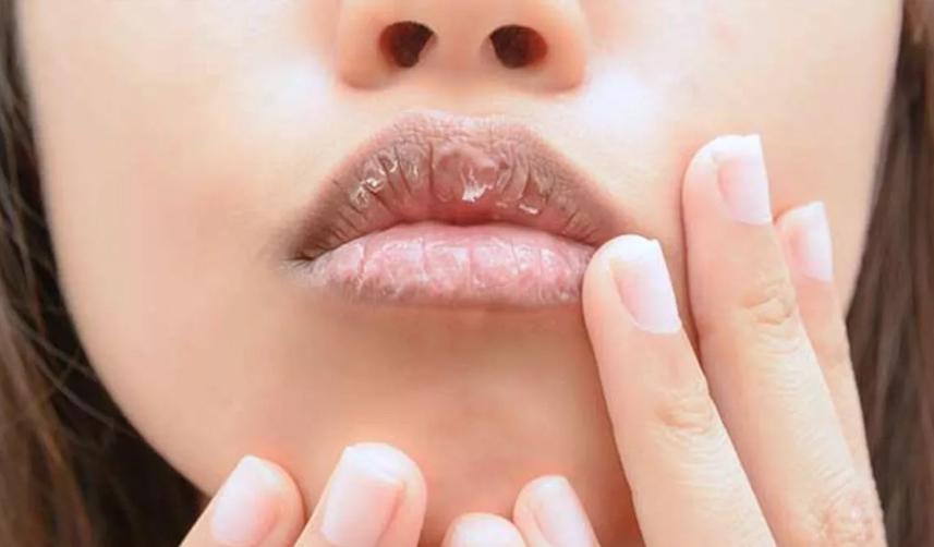Dudaklarınız yaz kış kuru ve çatlaksa dikkat!