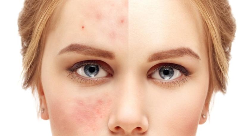 Sivilceleri kurutan bakım yöntemleri