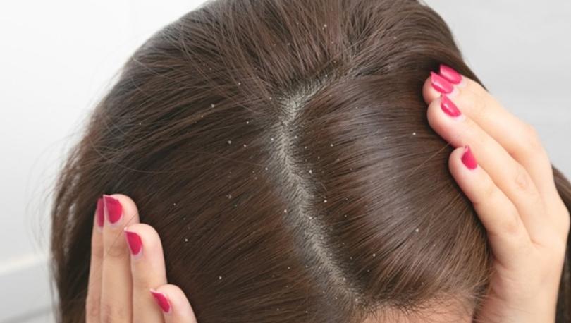 Kepek neden olur? Kepeği önleyen doğal yağlar