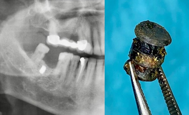 Yanağına saplanan metal parçasıyla 15 yıl yaşadı. Foto Galeri