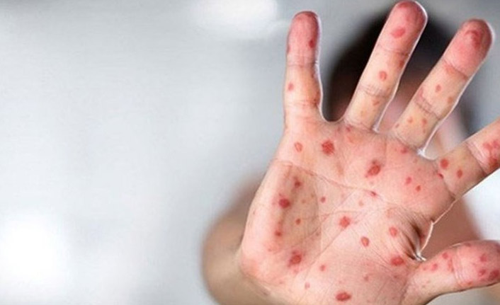 Çiçek aşısı maymun çiçeğine karşı koruyor mu?