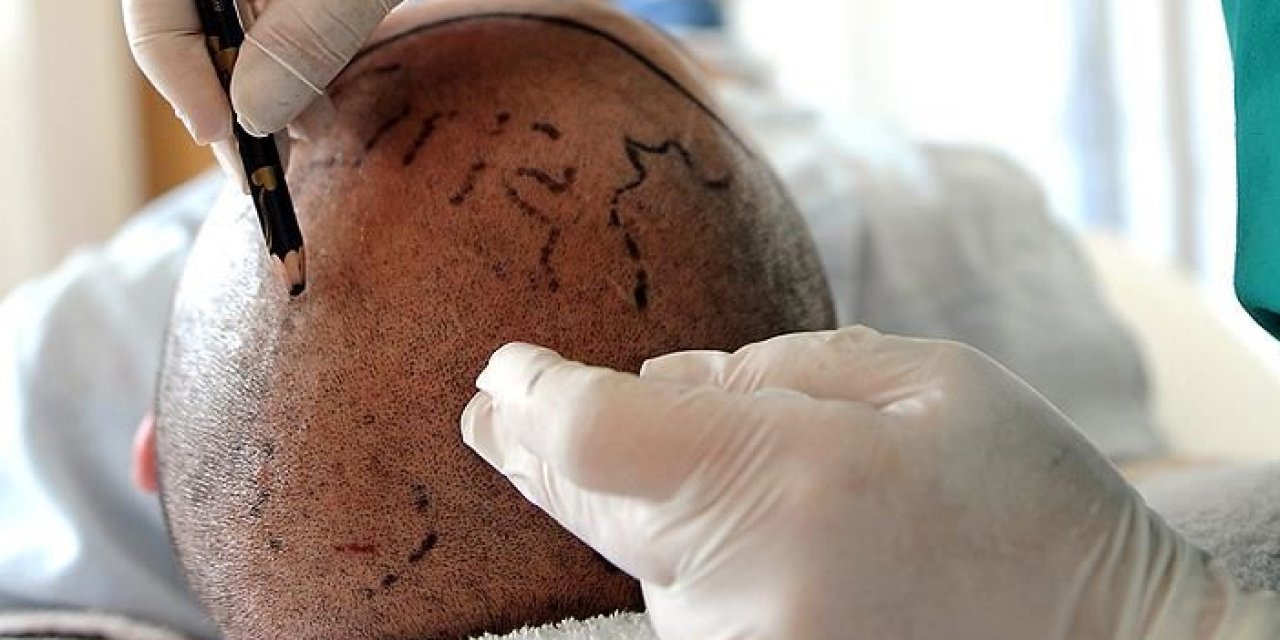 Saç ekimi nasıl yapılır? Kimler saç ekimi yaptırabilir?