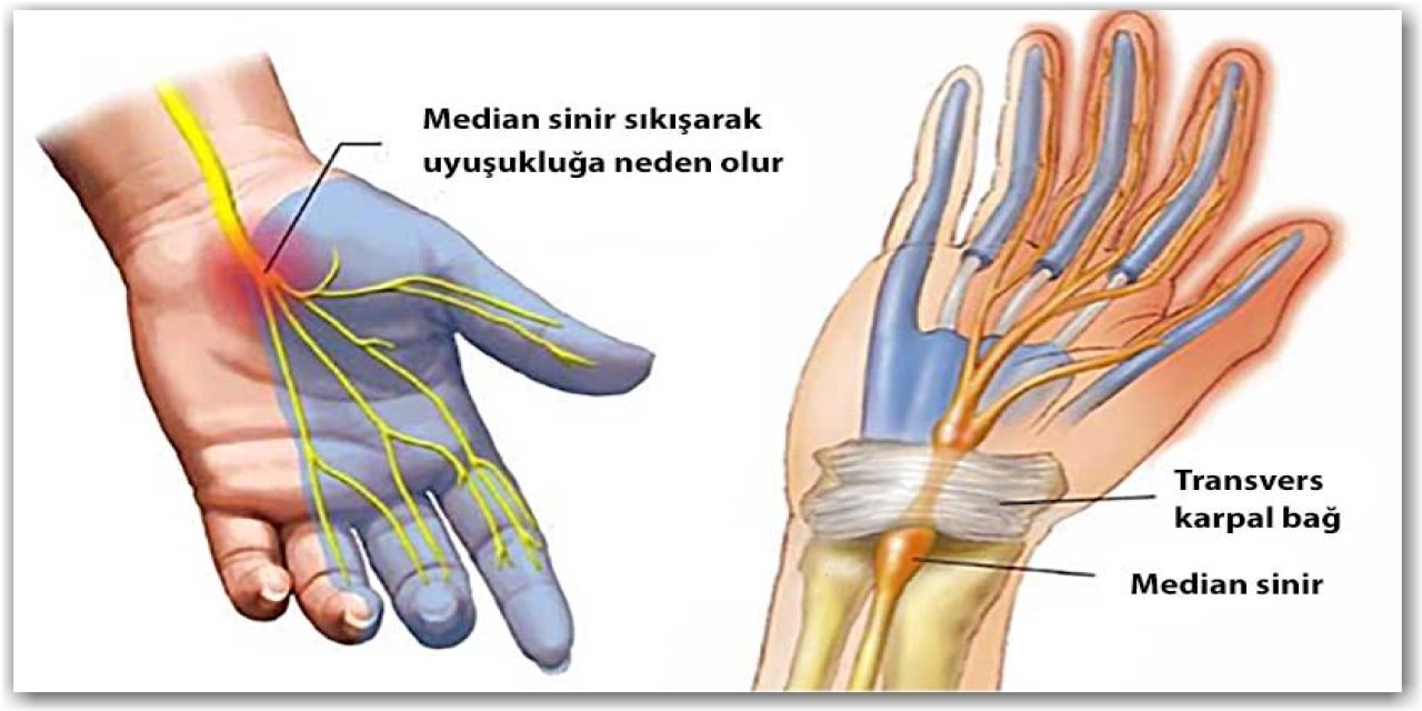 Karpal Tünel Sendromu nedir? Karpal Tünel Belirtileri, nedenleri, tedavisi nelerdir?