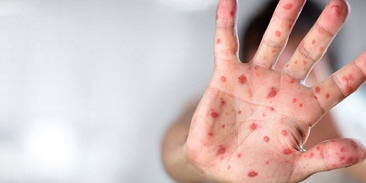 DSÖ'den maymun çiçeği uyarısı! Vakalar 90 binin üzerinde