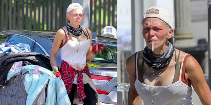 Sokakta yaşamaya başlayan modelin son hali korkuttu!