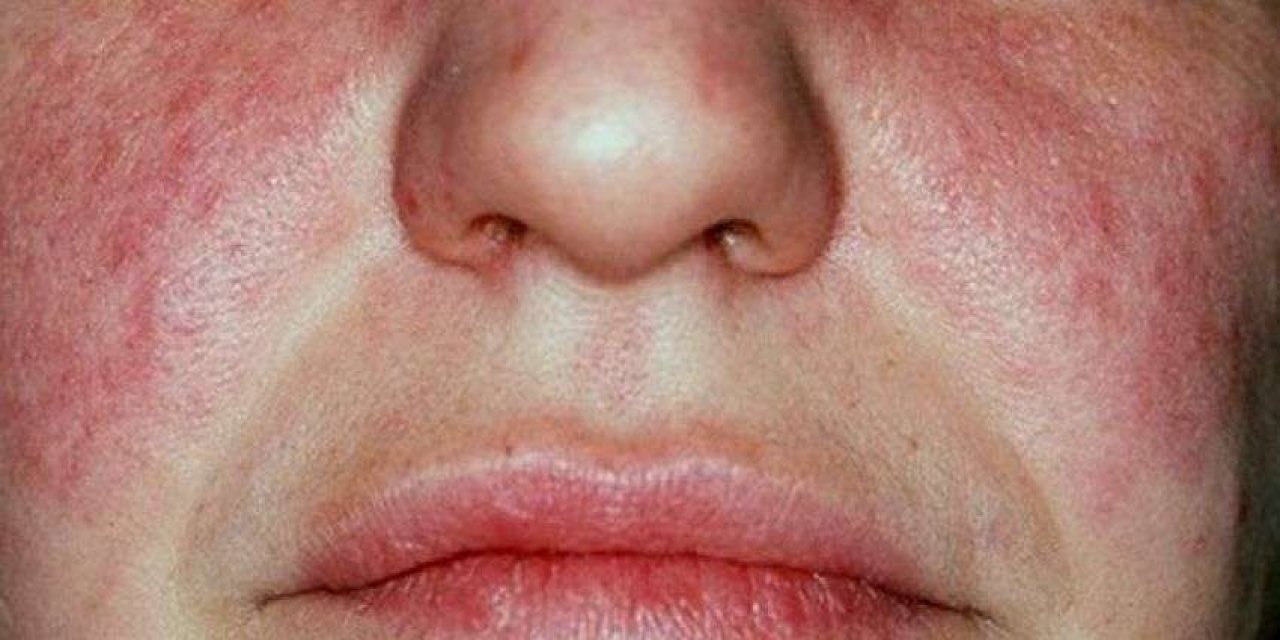 Pozitif Lupus (Kelebek Hastalığı) Nedir? Belirtileri nedir? Lupus hastalığı nasıl tedavi edilir?