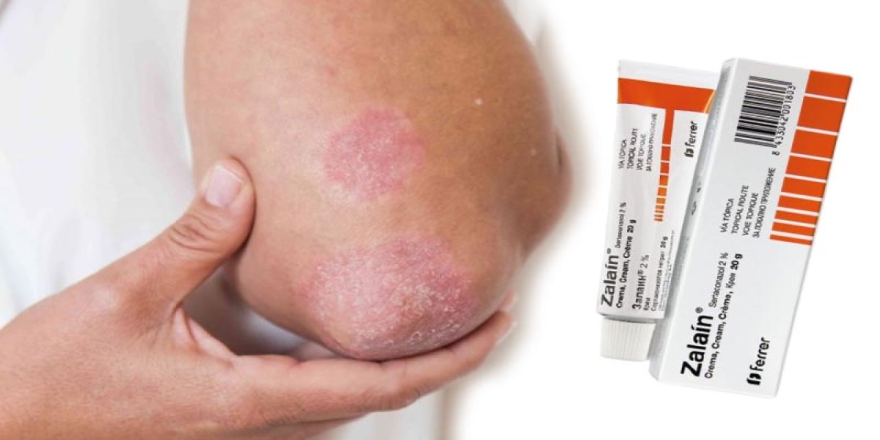 Zalain krem nedir, ne işe yarar? Nasıl kullanılır, fiyatı ne kadar, hangi Hastalıklar İçin Kullanılır