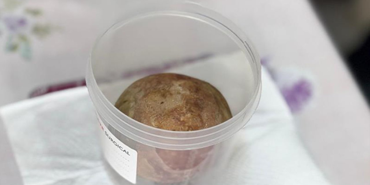 Giresun'da şaşırtan olay! Mesanesinden 370 gram taş çıkarıldı