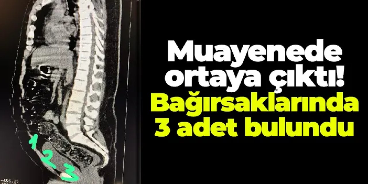 Gümüşhane’de şok operasyon! Bağırsaklarından Uyuşturucu Çıktı