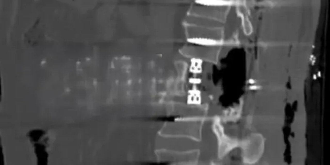 Bayburt’ta omur gövdesi çıkarılarak başarılı ameliyat gerçekleşti!