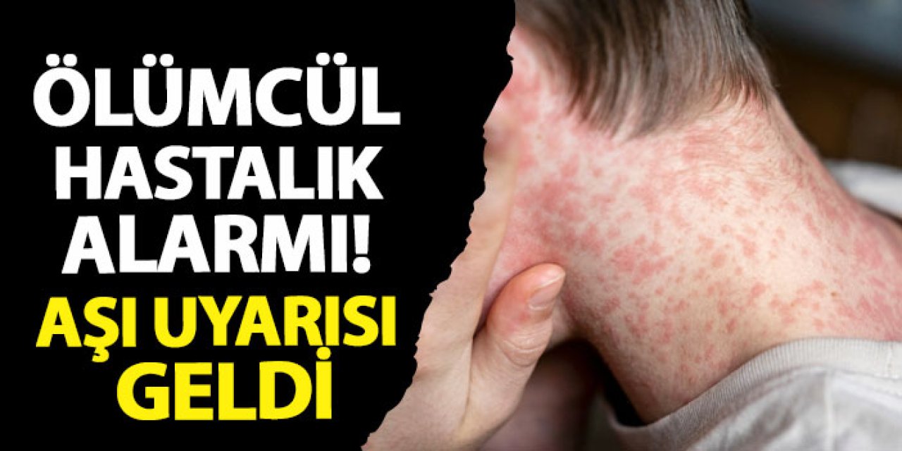 Kızamık alarmı! Aşı uyarısı geldi