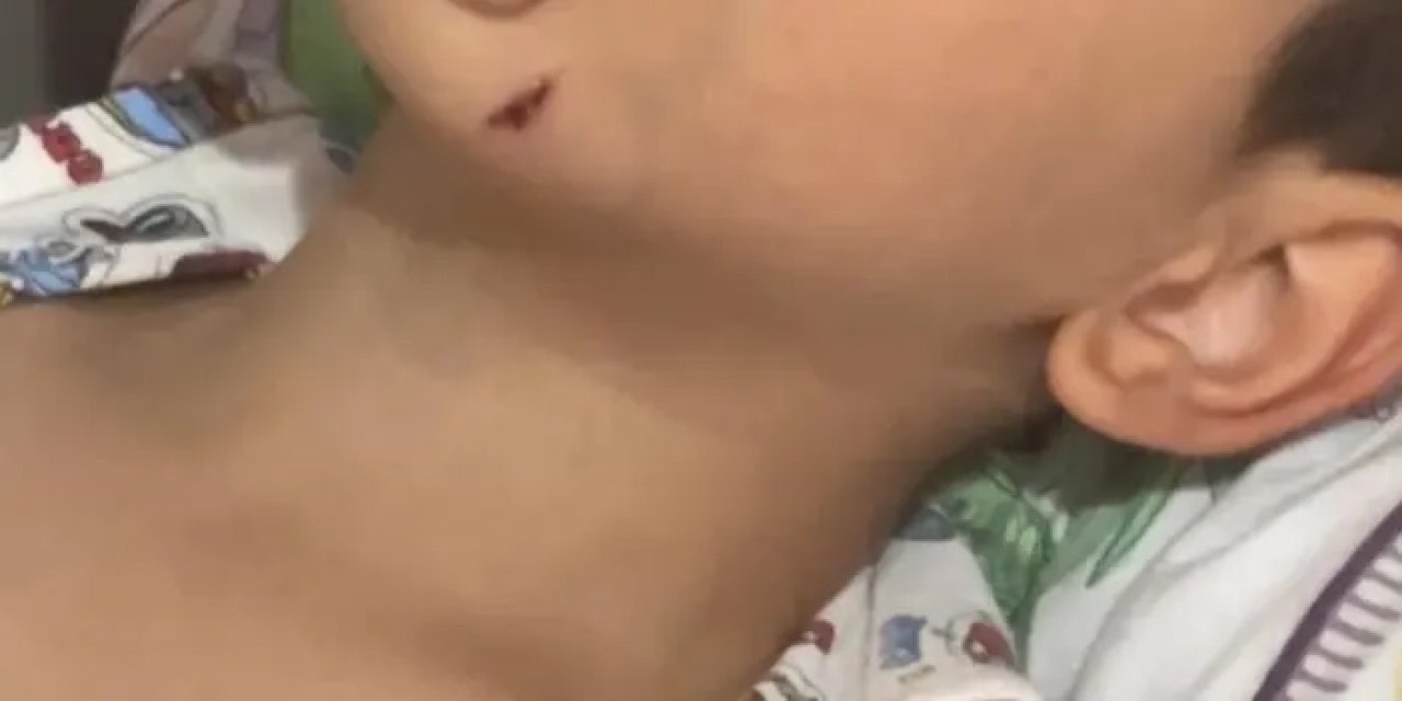 Rize’de 5 yaşındaki çocuk köpeğin saldırısına uğradı!