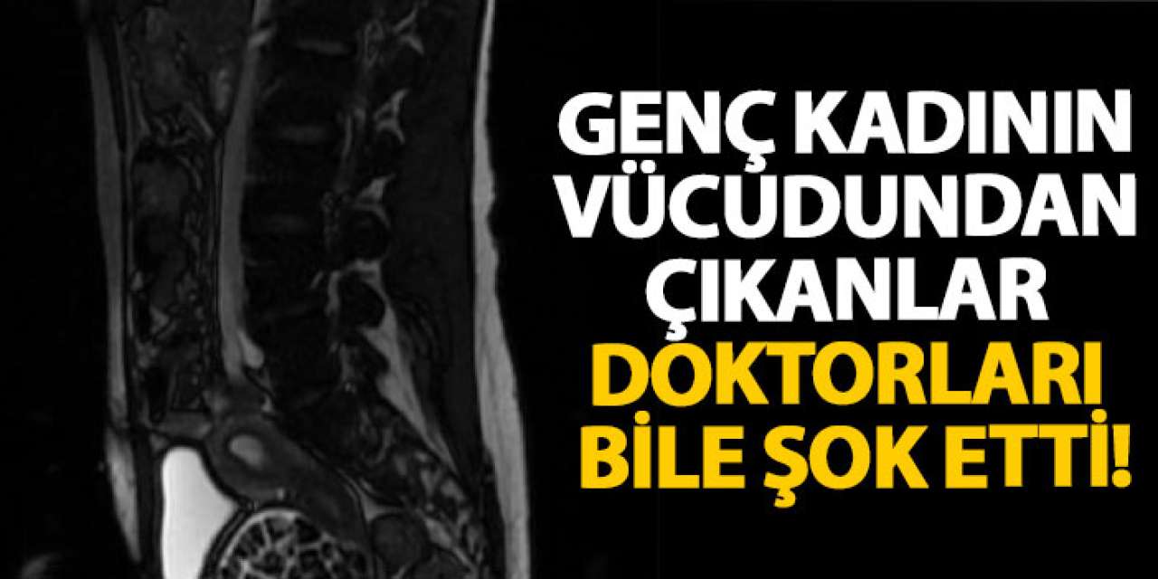 Genç kadının vücudundan çıkanlar doktorları bile şok etti!