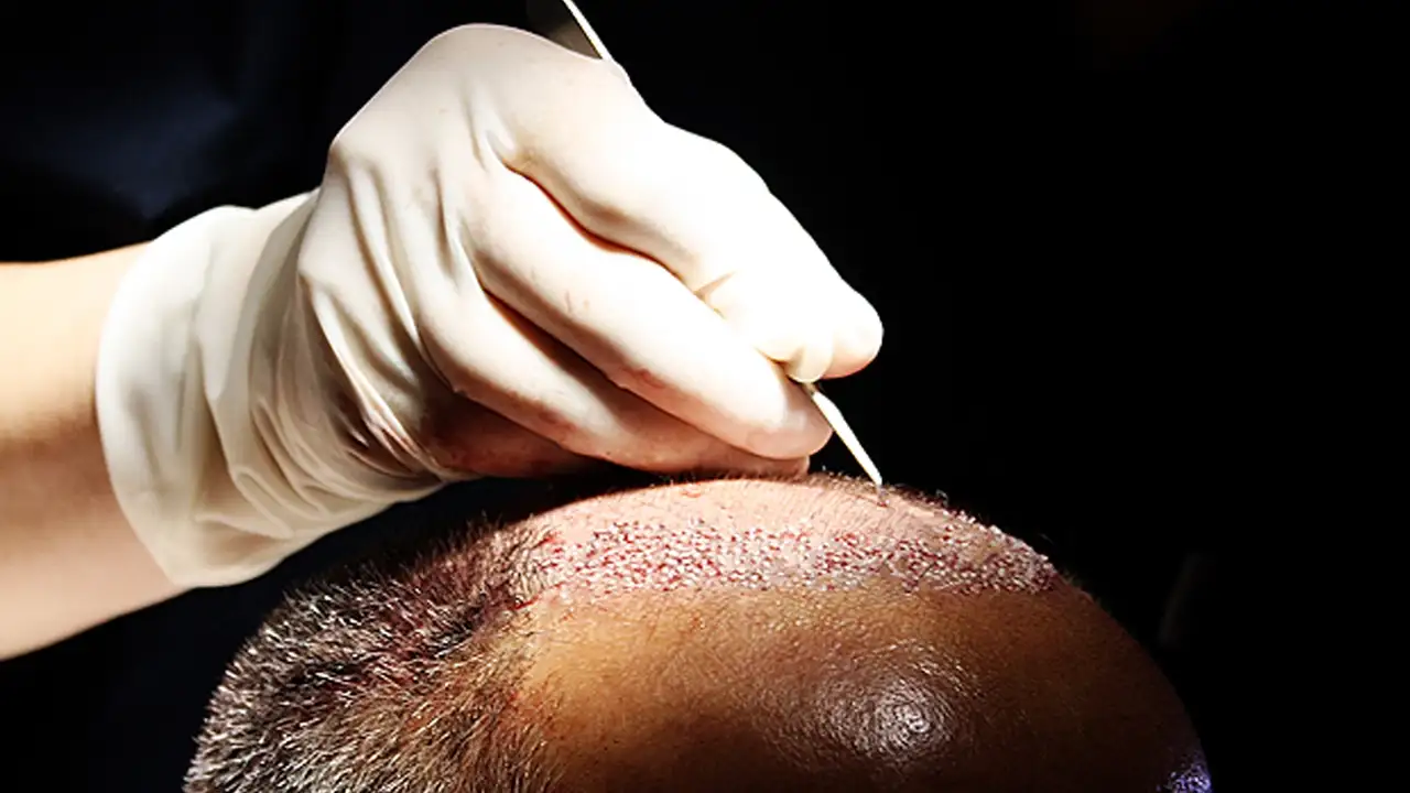 Trabzon’da saç ekimi sırasında fenalaştı: Hayatını kaybetti