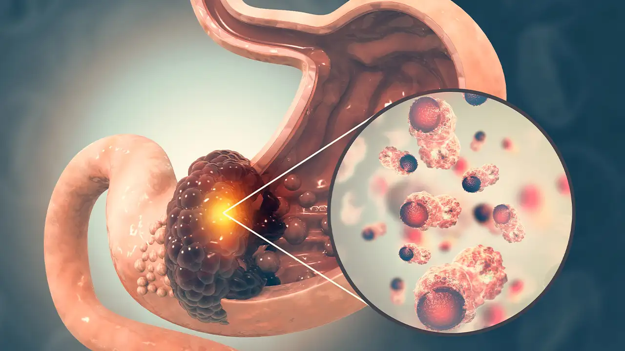 Mide kanseri belirtileri neler? Uzman isim risk faktörlerini anlattı