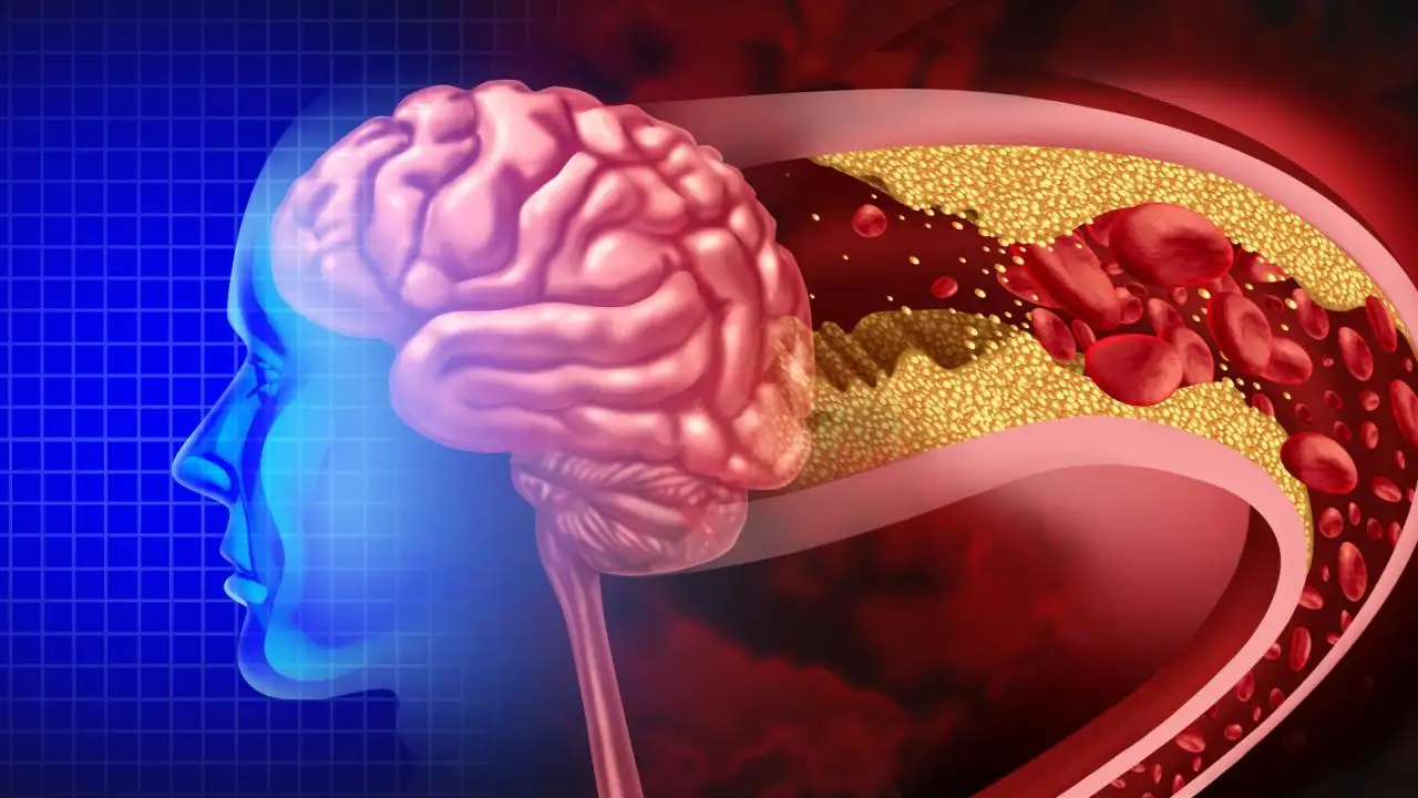 Beyin anevrizması nedir? Beyin anevrizması belirtileri ve riskleri neler?