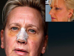 Saç kesmekten burnu düştü!