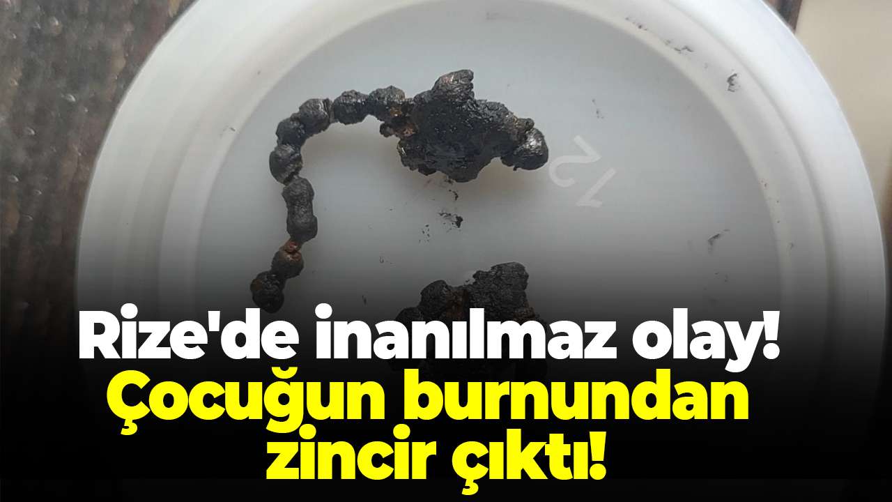 Rize'de inanılmaz olay! 5 yaşındaki çocuğun burnumdan zincir çıkarıldı