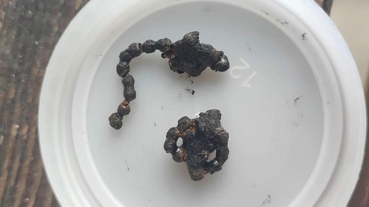 Rize'de inanılmaz olay! 5 yaşındaki çocuğun burnumdan zincir çıkarıldı