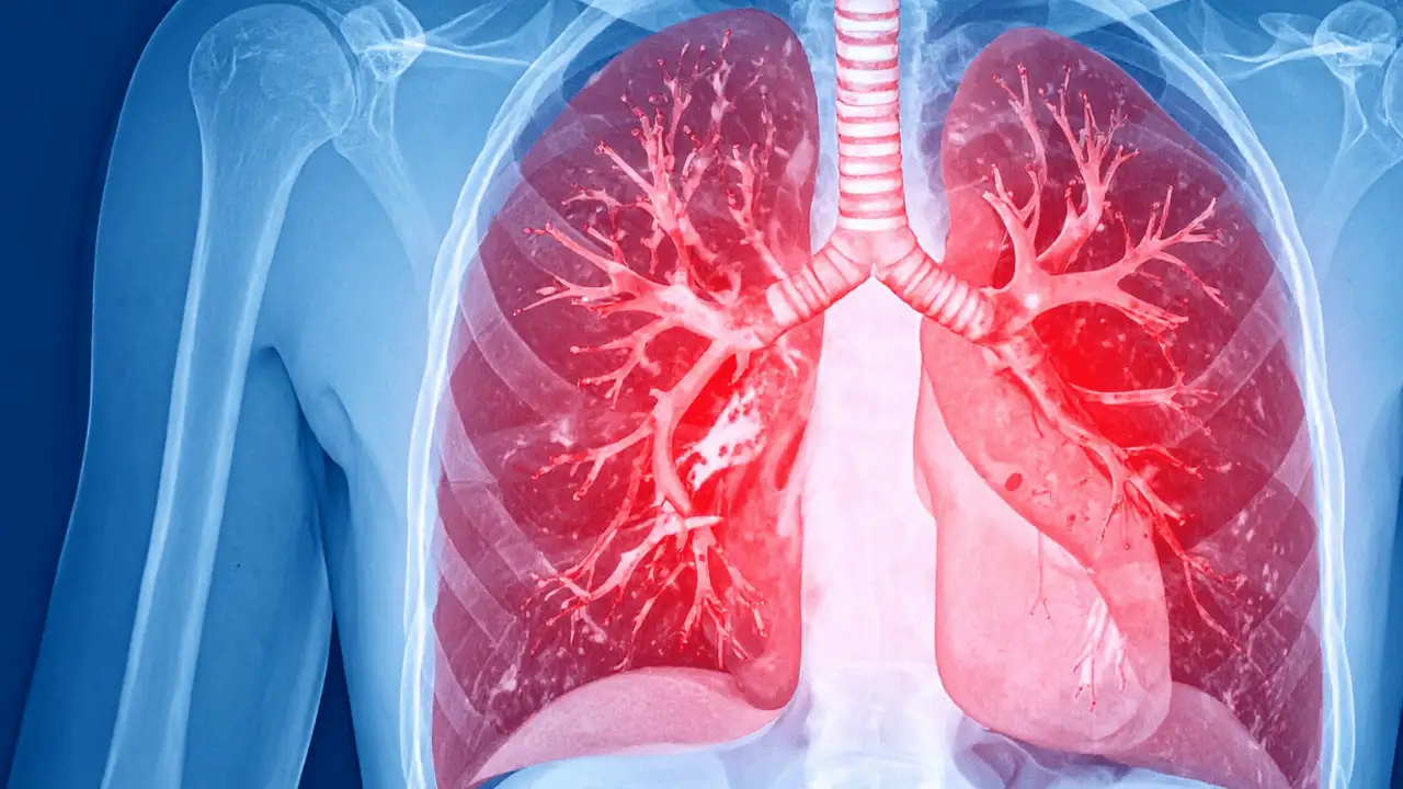 Pulmoner hipertansiyon nedir? Pulmoner hipertansiyon belirtileri neler?