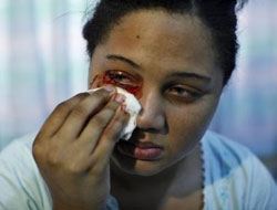 İnanılmaz olay! Bu kız kan ağlıyor