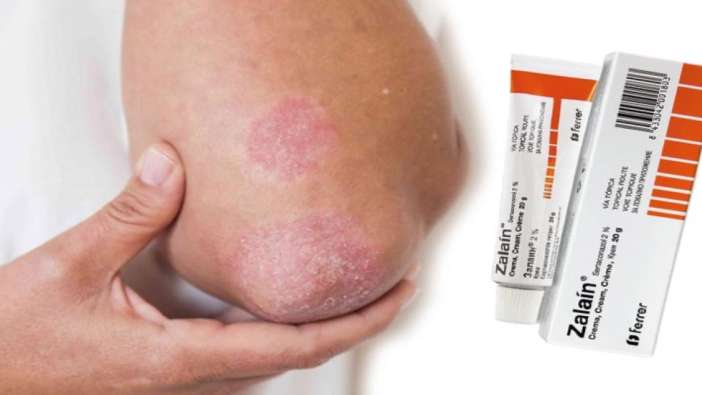 Zalain krem nedir, ne işe yarar? Nasıl kullanılır, fiyatı ne kadar?