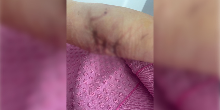 Samsun'da iki köpeğin saldırdığı anne-kız ucuz kurtuldu