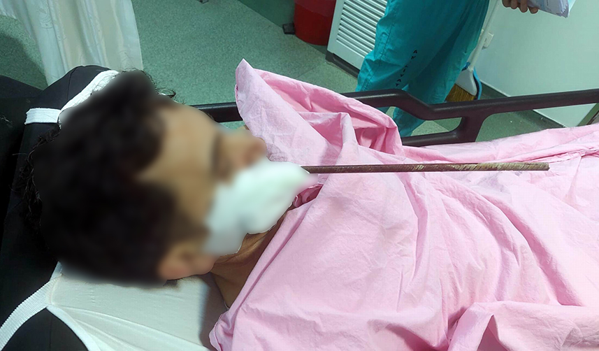 Giresun'da inşaattan düşen işçinin yüzüne demir saplandı