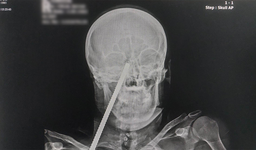 Giresun'da inşaattan düşen işçinin yüzüne demir saplandı