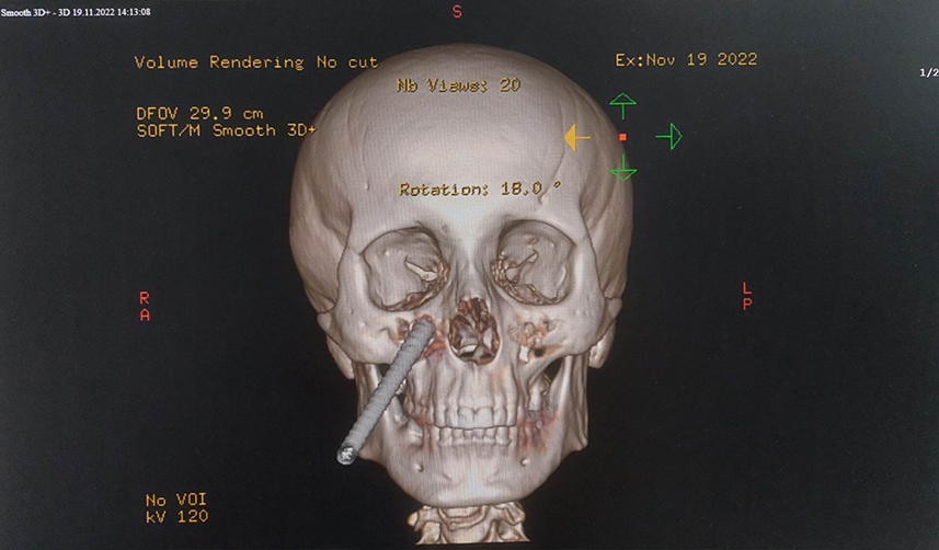 Giresun'da inşaattan düşen işçinin yüzüne demir saplandı