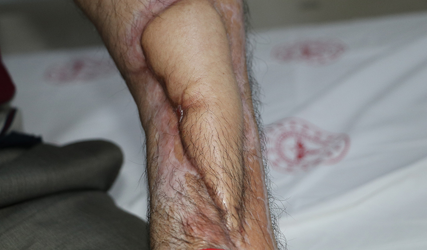 Çürüyen kolunu Trabzon'da doku nakli ile kurtarıldı