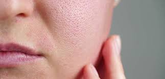 Gözenekli Cilt Bakımı Nasıl Olmalıdır?