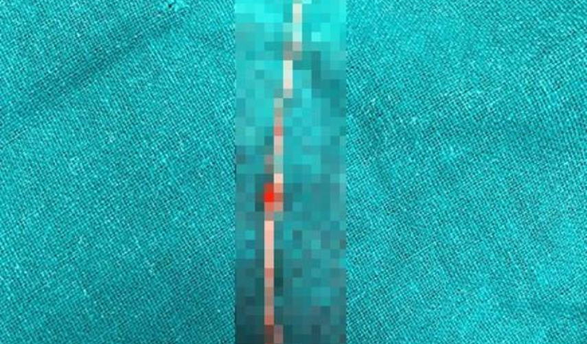 Sivrisineğin ısırdığı kadının yanağından çıkana doktorlar bile inanamadı