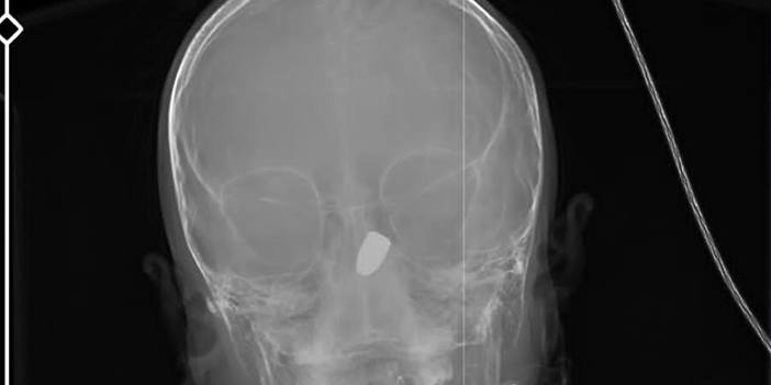 Trabzon'da başına yorgun mermi isabet eden Kerem, kardeşiyle aynı hastanede