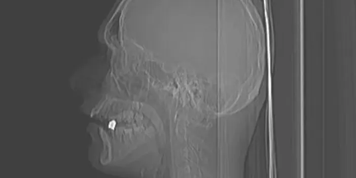 İstanbul'da maganda kurşununun hedefi oldu! Boynundan girdi çenesine saplandı 