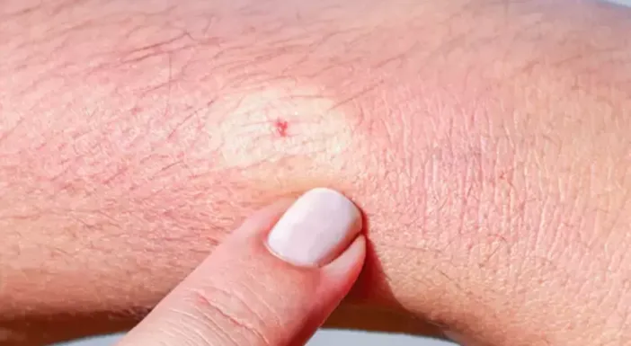 Kene nedir, ısırınca neler yapılmalı Kene ısırığı nasıl olur, tedavisi nedir