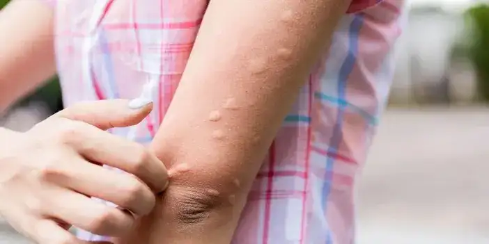 Sivrisinekler Neden Bazı İnsanları Daha Çok Isırıyor? İşte Bilimsel Nedenler