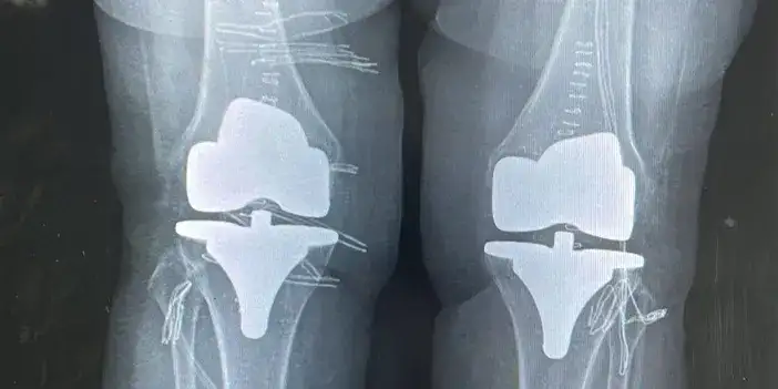 bayburt-diz-ameliyati