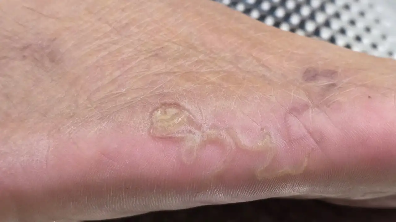 kancali-kurt-hastaligi