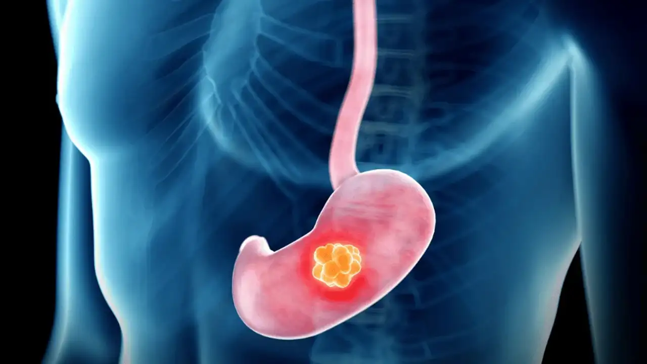 mide-kanseri-belirtileri-neler