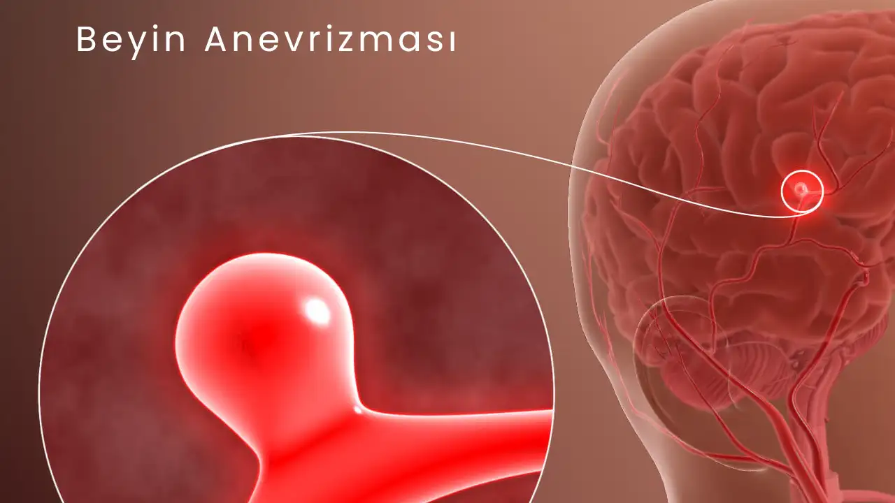 beyin-anevrizmasi-nedir