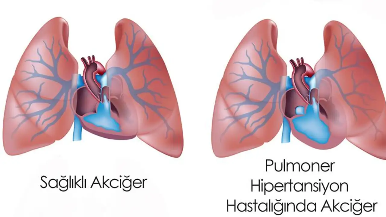 pulmoner-hipertansiyon-nedir