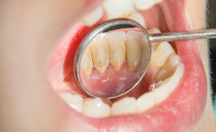 Diş Taşı Nedir, Neden Oluşur?  İşte Diş Taşı Temizliği Nasıl Yapılır?