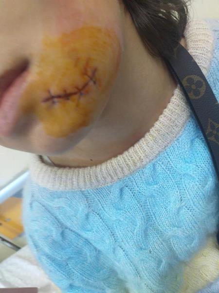 Rize'de sokak köpeği saldırdı! Çocuk yüzünden yaralandı